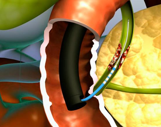 ELECTRODO DE ABLACION POR RADIOFRECUENCIA BIPOLARELRA